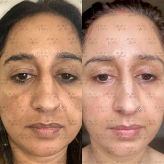 Amez Glow Pimple & Pigmentation Kit