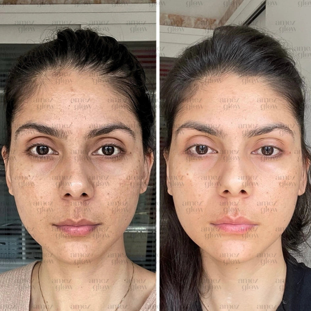 Amez Glow Pimple & Pigmentation Kit
