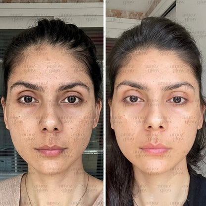 Amez Glow Pimple & Pigmentation Kit