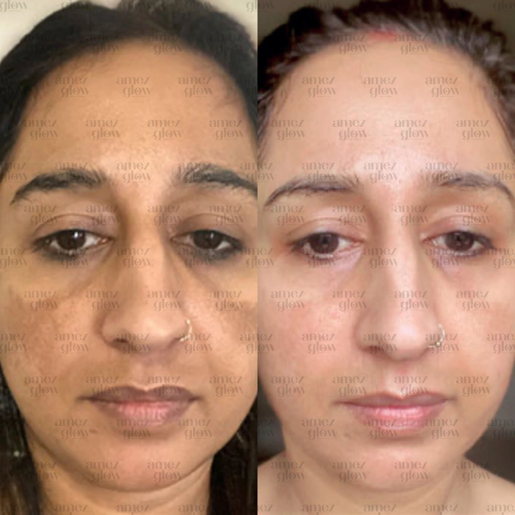 Amez Glow Pimple & Pigmentation Kit