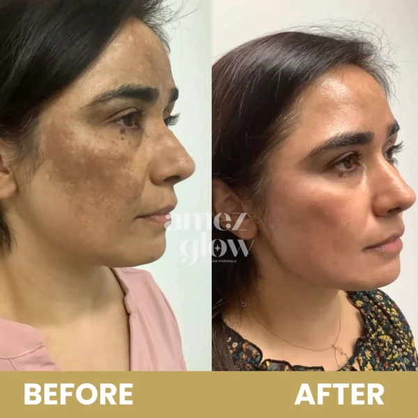 PIMPLE & PIGMENTATION KIT by AMEZ GLOW - Image 2