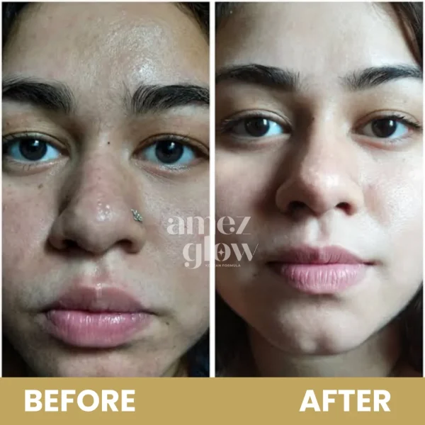 PIMPLE & PIGMENTATION KIT by AMEZ GLOW - Image 5